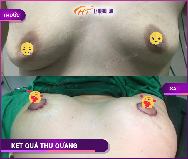 Hình ảnh kết quả thu quầng tại Dr Hoàng Tuấn